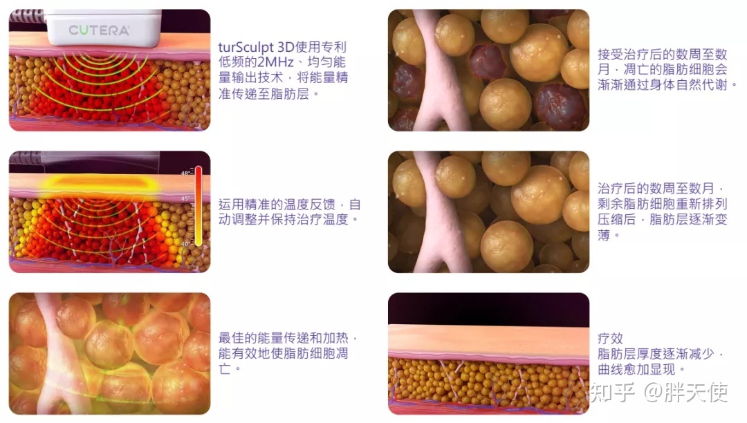 最新溶脂术重塑自信美丽新篇章🌟